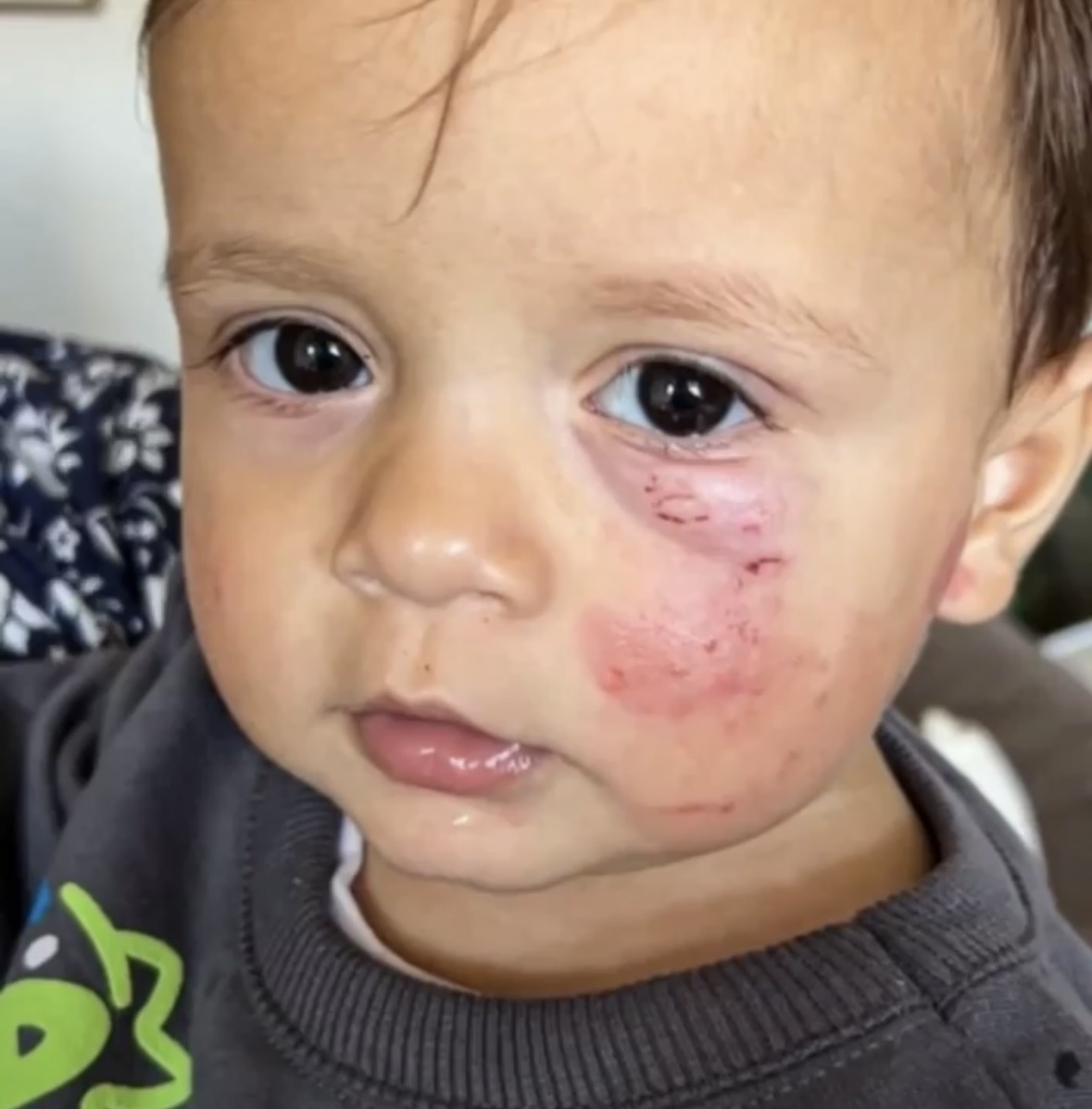 Bebê de 14 meses fica ferido após ser mordido em creche de Criciúma 